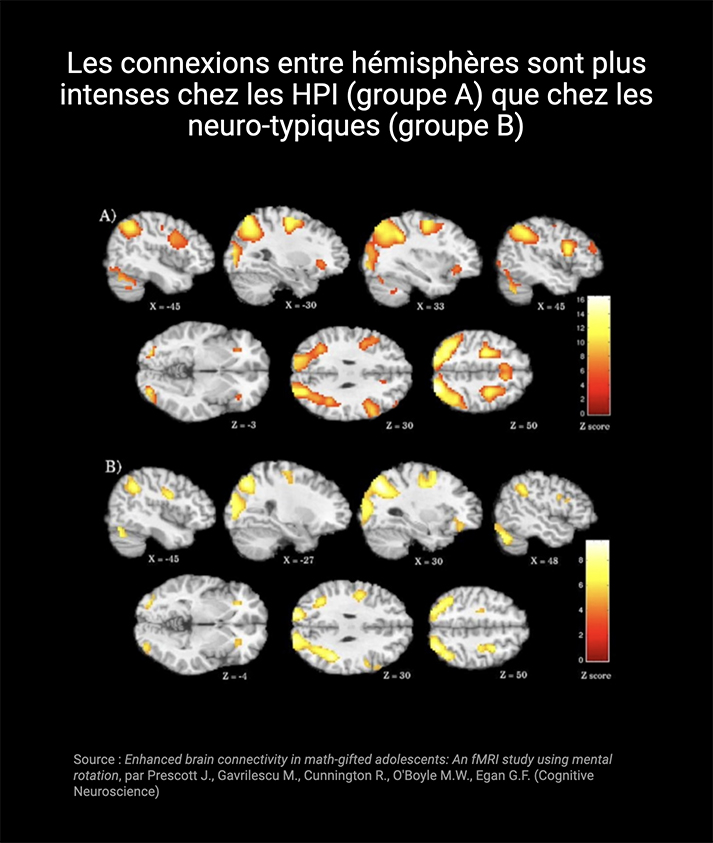 Les hémisphères du cerveau d'un HPI sont mieux connectés